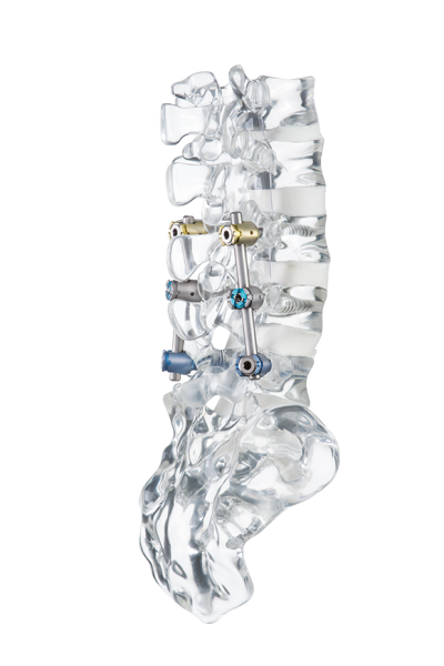 uCentum comprehensive posterior system with glas model from ulrich medical